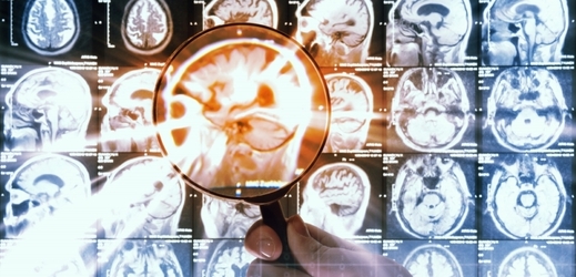 Rentgenové snímky mozku s nádorem (ilustrační foto).