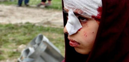 Zraněná syrská dívka (ilustrační foto).