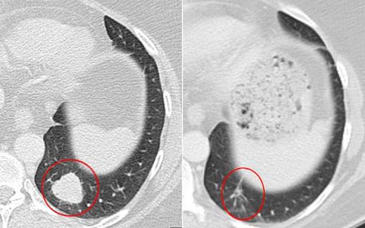 Rentgenové snímky nádoru testovaného pacienta před a po léčbě.