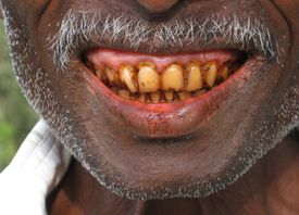 Žvýkání betelu zvyšuje riziko rakoviny ústní, varují lékaři.