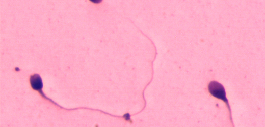 Na snímku je zobrazení spermií z morfologického vyšetření, při kterém se zkoumá jejich kvalita.