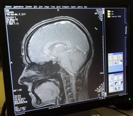Při Parkinsonově chorobě je postižena značná část mozkových buněk (ilustrační foto).