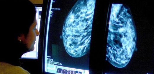 Ženy v Praze trpí častěji nádorem prsu.