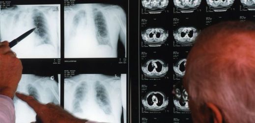 Ročně v Česku rakovinou plic onemocní na 6500 lidí.