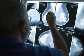 Radiolog zkoumá snímky z mamografu.
