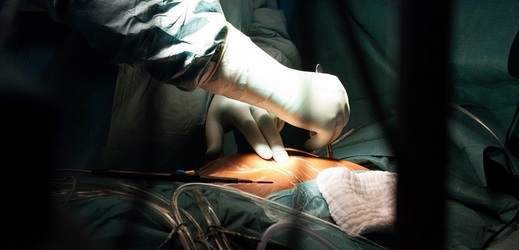 Lékaři museli při operaci srdeční vady sáhnout k nestandardnímu řešení (ilustrační foto).