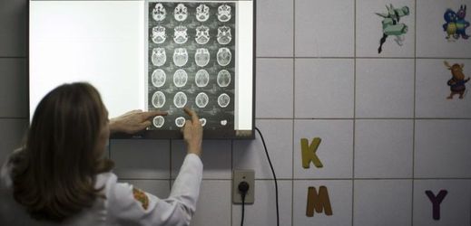Brazilská doktorka Angela Rochaová ukazuje rentgenové snímky mozku dítěte narozeného s mikrocefalií (nedostatečně vyvinutou hlavou). Za hlavní příčinu onemocnění je označován virus zika.