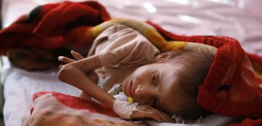 Podvyživené dítě v Jemenu. 