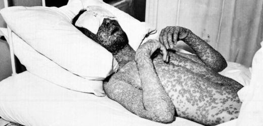 Pravé neštovice zabily jen v minulém století 300-500 milionů lidí.