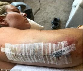 Lindsey Vonnová je po operaci zlomené ruky