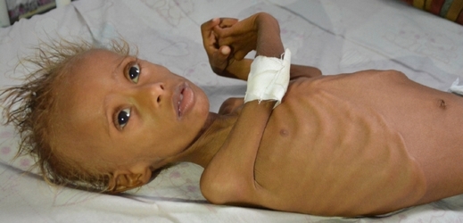 Těžce podvyživeno je v Jemenu podle odhadů asi půl milionu dětí.