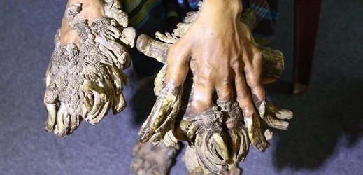 Bangladéšan trpí onemocněním, kvůli kterému mu na rukou a nohou vyrostly několikakilogramové bradavice.