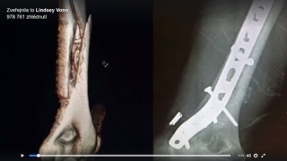 Rentgenový snímek zlomené ruky Lindsey Vonnové.