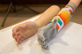 Prezentace technologie bionické protézy britské společnosti Touch Bionics pro pacienty po amputaci ruky.