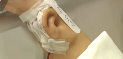 Ucho bylo vypěstováno na předloktí pacienta.