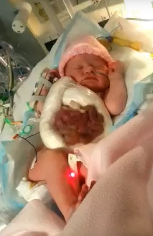 Novorozeně se narodilo s rozštěpem břišní dutiny.