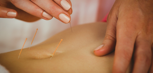 Akupunktura (ilustrační foto).