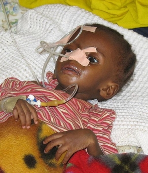 Těžce podvyživené dítě v nigerijské nemocnici.