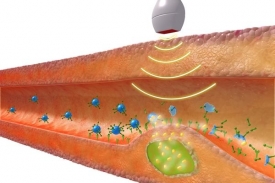 Ultrazvuk aktivuje léky v mikrobublinkách přímo v místě určení.