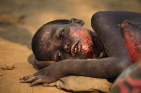 Popálené hutské dítě na útěku z Rwandy roku 1994.