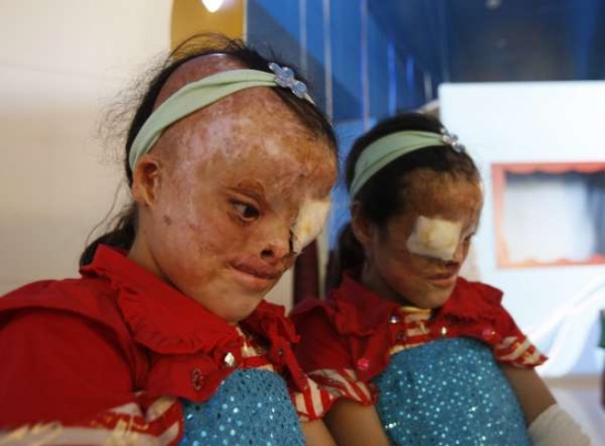 Devítiletá Samira, oběť bojův Iráku. Operována Lékaři bez hranic.