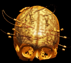 Studium mozku pomocí elektrod bylo možné jen v rámci přípravy operace.
