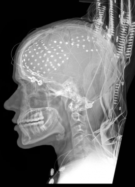 Rentgenový snímek mozku s umístěnými elektrodami.