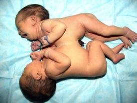 Siamská dvojčata srotslá bříšky (ilustrační foto).