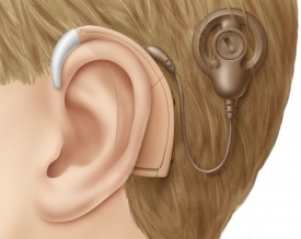 Implantát není naslouchadlo. Zvuky převádí na elektrické signály.