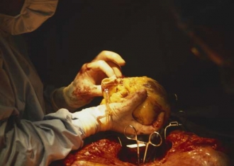 Srdce vyjímané z těla za účelem transplantace (ilustrační foto).
