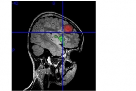 Červené je centrum epileptických záchvatů, zelené řečové.