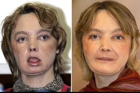 Isabelle Dinoireová: dva měsíce a jeden rok po operaci (s make-upem).