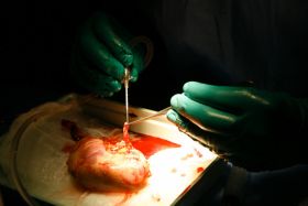 Filipíny coby meta transplantací ledvin končí.