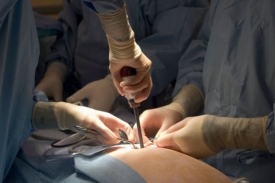 Operace se provádí laparoskopicky (ilustrační foto).
