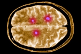 Magnetická rezonance odhalila oblasti mozku poškozené nemocí.