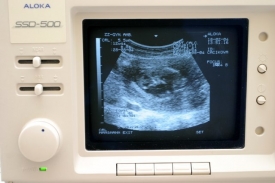 Pohyb dítěte na ultrazvuku.