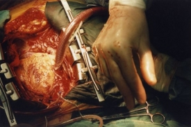 Transplantace srdce se během 40 let stala poměrně bezproblémovou.