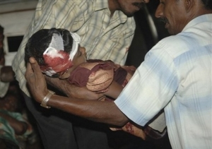 Zraněné tamilské dítě v místní nemocnici.